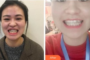 溫州牙博士口腔門診部魏謀達(dá)整形價(jià)格表附牙齒隱形矯正案例展示