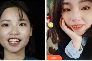 溫州牙博士口腔門診部呂昊昕整形價(jià)格表附金屬托槽矯正案例展示