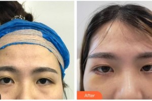 嘉興華山醫(yī)療美容醫(yī)院陳榮忠整形價(jià)格表附外切祛眼袋案例展示