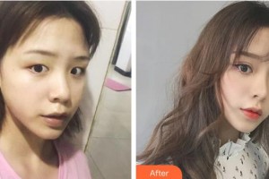 嘉興華山醫(yī)療美容醫(yī)院傘光整形價(jià)格表附切開雙眼皮案例展示