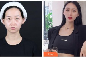 嘉興市第一醫(yī)院整形外科徐剛整形價(jià)格表附內(nèi)切祛眼袋案例展示