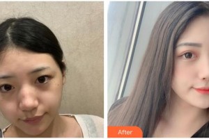 嘉興華山醫(yī)療美容醫(yī)院謝惠芬整形價(jià)格表附激光祛斑案例展示