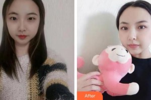 嘉興華山醫(yī)療美容醫(yī)院李紅波整形價(jià)格表附切開雙眼皮案例展示