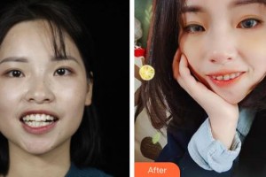 嘉興市曙光中西醫(yī)結(jié)合醫(yī)院整形美容科趙艷整形價(jià)格表附金屬托槽矯正案例展示