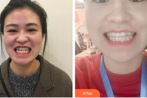 嘉興市曙光中西醫(yī)結(jié)合醫(yī)院整形美容科趙云整形價(jià)格表附牙齒隱形矯正案例展示