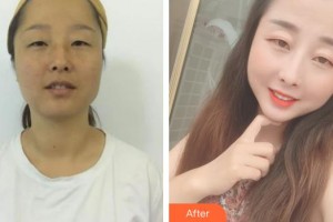 嘉興華山醫(yī)療美容醫(yī)院郭豪整形價(jià)格表附白瓷娃娃案例展示