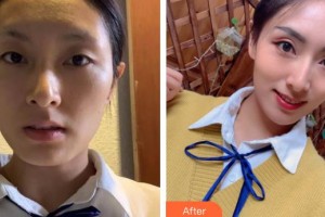 嘉興禾美醫(yī)療美容醫(yī)院柳軍整形價格表附埋線提升案例展示