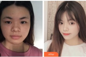 嘉興禾美醫(yī)療美容醫(yī)院梁海元整形價格表附埋線提升案例展示