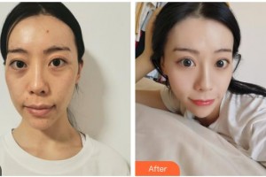 嘉興禾美醫(yī)療美容醫(yī)院趙學燕整形價格表附埋線提升案例展示