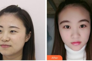 嘉興愛爾眼科醫(yī)院張文鳳整形價格表附眼部綜合案例展示