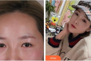 嘉興愛爾眼科醫(yī)院李文生整形價格表附眼部綜合案例展示