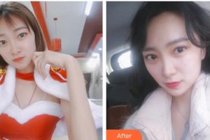 嘉興愛爾眼科醫(yī)院趙春會整形價格表附切開雙眼皮案例展示