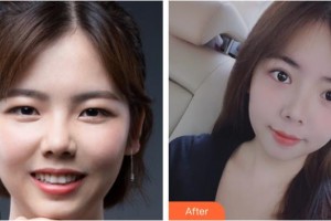 嘉興愛爾眼科醫(yī)院許正俊整形價格表附切開雙眼皮案例展示