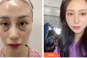 嘉興愛爾眼科醫(yī)院王春芳整形價格表附外切祛眼袋案例展示