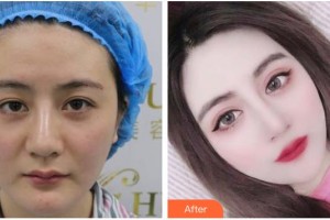 嘉興愛爾眼科醫(yī)院李邵偉整形價格表附眼部綜合案例展示