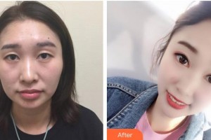 嘉興愛爾眼科醫(yī)院李光輝整形價格表附埋線雙眼皮案例展示