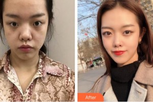 嘉興愛爾眼科醫(yī)院陳自淼整形價格表附切開雙眼皮案例展示