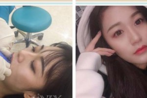 嘉興口腔醫(yī)院米蘭整形價格表附牙齒隱形矯正案例展示