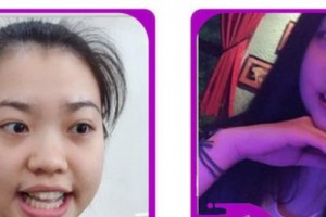 嘉興口腔醫(yī)院沈斌整形價格表附牙齒隱形矯正案例展示