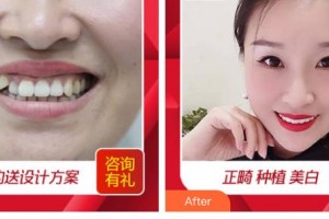 嘉興口腔醫(yī)院張國平整形價格表附隱形托槽矯正案例展示