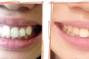 嘉興口腔醫(yī)院曾聰整形價格表附牙齒隱形矯正案例展示