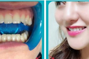 嘉興嘉誠口腔醫(yī)院谷丹整形價格表附冷光美白案例展示