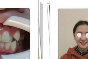 嘉興嘉誠口腔醫(yī)院苗華明整形價格表附金屬托槽矯正案例展示