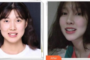 嘉興嘉誠口腔醫(yī)院吳雪琪整形價格表附牙齒隱形矯正案例展示