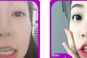 嘉興嘉誠口腔醫(yī)院王菊慶整形價格表附牙齒隱形矯正案例展示