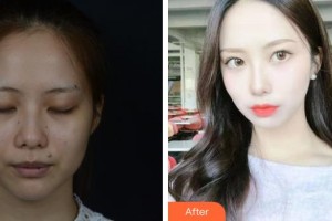 嘉興市中醫(yī)醫(yī)院眼科余其智整形價格表附埋線雙眼皮案例展示