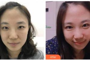 嘉興市中醫(yī)醫(yī)院眼科翁文慶整形價格表附眼部綜合案例展示