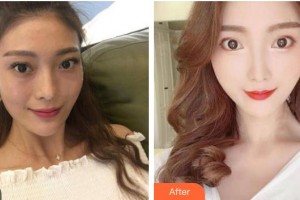 嘉興市中醫(yī)醫(yī)院眼科蔣麗君整形價格表附外切祛眼袋案例展示