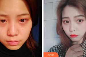 湖州曙光醫(yī)療美容門診部羅敏整形價格表附激光祛斑案例展示