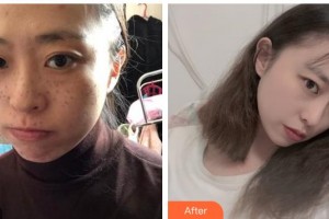 湖州曙光醫(yī)療美容門診部李玲整形價格表附激光祛斑案例展示