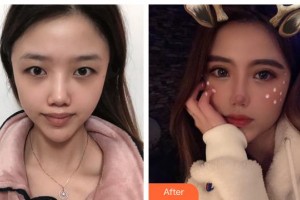 湖州尚麗醫(yī)療美容門診部譚成林整形價(jià)格表附眼部綜合案例展示