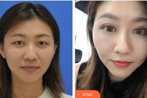 湖州長興愛爾眼科醫(yī)院趙英杰整形價(jià)格表附定點(diǎn)雙眼皮案例展示