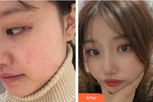 湖州愛爾眼科醫(yī)院莫百軍整形價(jià)格表附切開雙眼皮案例展示