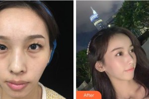 湖州愛爾眼科醫(yī)院吳元奇整形價(jià)格表附激光去黑眼圈案例展示