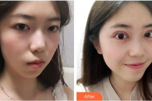 湖州愛爾眼科醫(yī)院俞臻整形價(jià)格表附開內(nèi)眼角案例展示