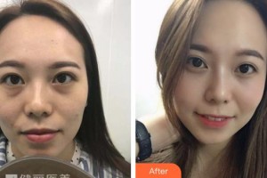 湖州愛爾眼科醫(yī)院陳健整形價(jià)格表附激光去眼袋案例展示