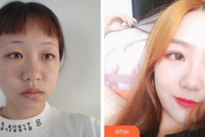 湖州愛爾眼科醫(yī)院聞萍整形價(jià)格表附切開雙眼皮案例展示