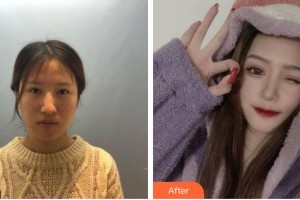 湖州愛爾眼科醫(yī)院吳新如整形價(jià)格表附眼部綜合案例展示