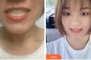 湖州鼎植口腔醫(yī)院曹振整形價(jià)格表附牙齒隱形矯正案例展示