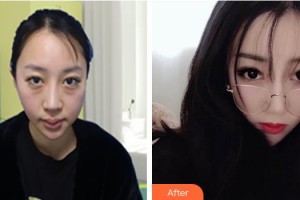 湖州長(zhǎng)興愛(ài)爾眼科醫(yī)院楊晨皓整形價(jià)格表附激光去眼袋案例展示