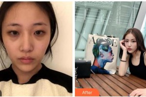 湖州長(zhǎng)興愛(ài)爾眼科醫(yī)院周曉紅整形價(jià)格表附內(nèi)切祛眼袋案例展示