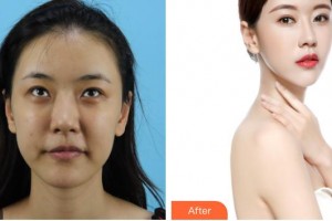 湖州長(zhǎng)興愛(ài)爾眼科醫(yī)院高路整形價(jià)格表附開(kāi)內(nèi)眼角案例展示