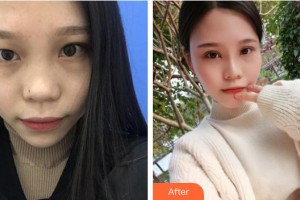 湖州長(zhǎng)興愛(ài)爾眼科醫(yī)院金志華整形價(jià)格表附定點(diǎn)雙眼皮案例展示