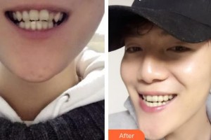 湖州溫馨口腔診所王大鵬整形價(jià)格表附牙齒矯正案例展示