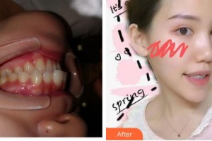 湖州溫馨口腔診所溫新鳳整形價(jià)格表附金屬托槽矯正案例展示