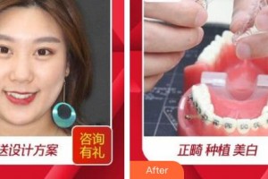 湖州溫馨口腔診所方云鶴整形價(jià)格表附隱形托槽矯正案例展示